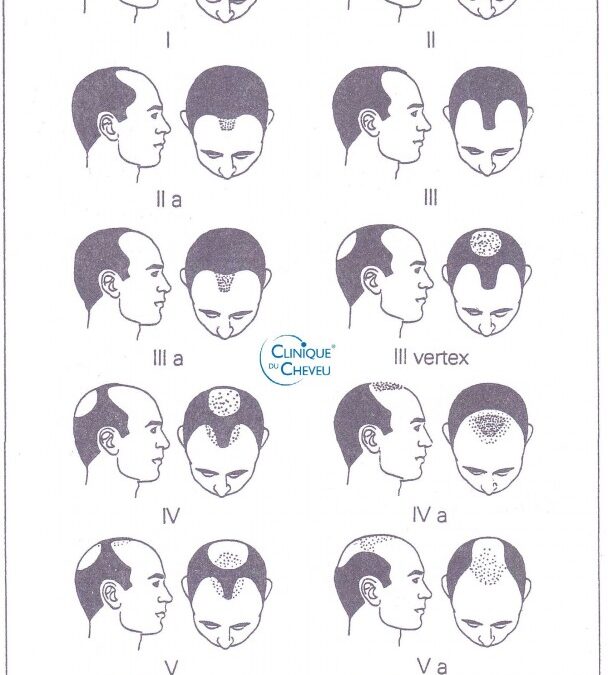 Les différentes phases de la calvitie chez l’homme